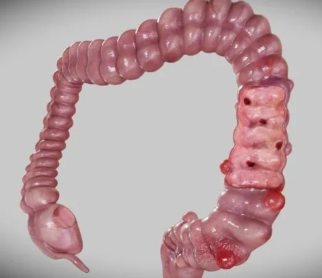PBR Game 3D Models – Diverticulosis And Diverticulitis
