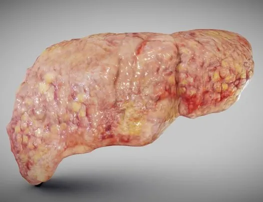 PBR Game 3D Models – Fatty Liver